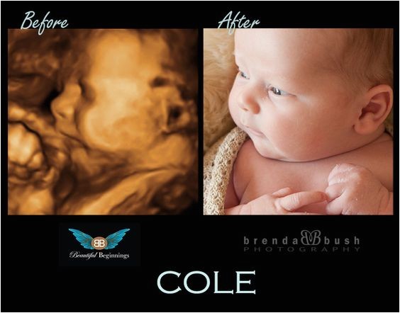 3d Ultrasound Bronx Ny Best 3d Ultrasound In Westchester History Of the Ultrasound