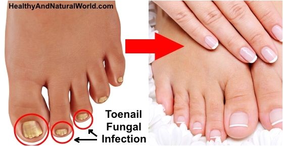 toenail fungus home remedies