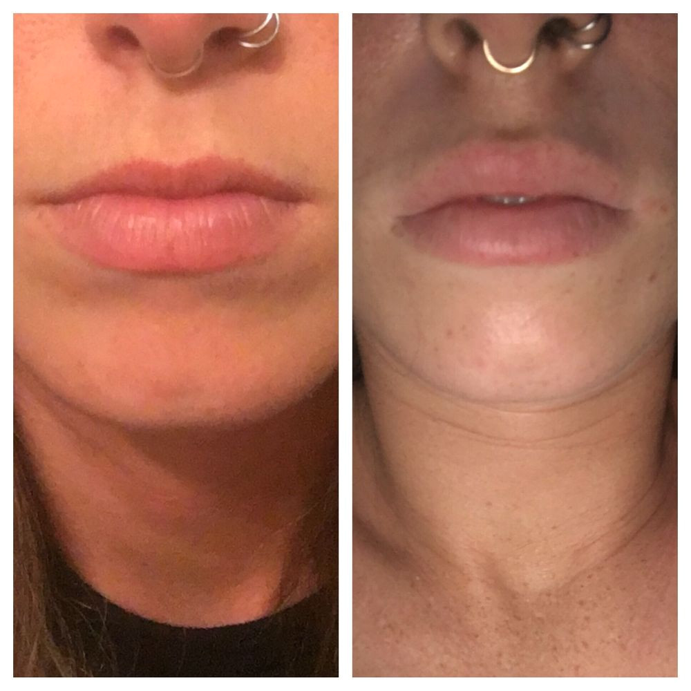 photo of waterfront laser wellness portland or united states juvederm ultra