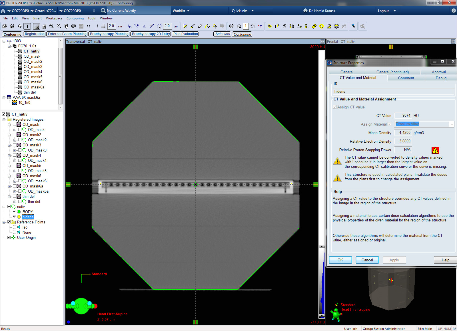 native contains the original kfj ct data only a few high density voxels were segmented separately to enable acurosxb dose calculation