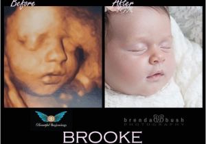 3d Ultrasound Bronx Ny Best 3d Ultrasound In Westchester History Of the Ultrasound