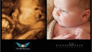 3d Ultrasound Bronx Ny Best 3d Ultrasound In Westchester History Of the Ultrasound