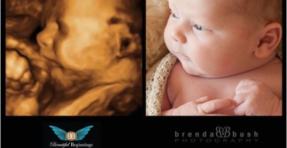 3d Ultrasound Bronx Ny Best 3d Ultrasound In Westchester History Of the Ultrasound