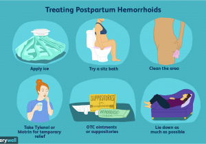 Best Pads for Bleeding after Delivery Hemorrhoids after Giving Birth at Home Treatments
