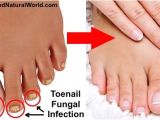 Colloidal Silver Nail Fungus 25 Best Ideas About toenail Fungus Home Remedies On