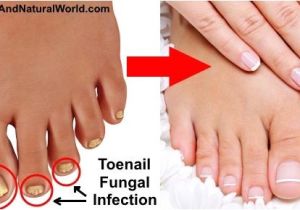 Colloidal Silver Nail Fungus 25 Best Ideas About toenail Fungus Home Remedies On