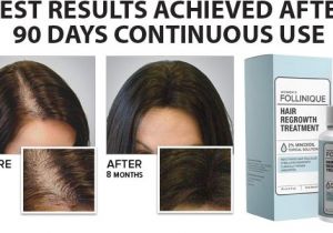 Follinique Hair Growth Reviews Follinique Reviews Advance Minoxidil Fda Approve Hair