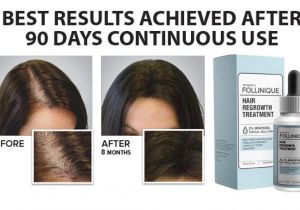 Follinique Hair Regrowth Treatment Follinique Uses Side Effects Price Interactions and